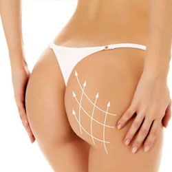 BODY (CROSS LINKED HA) FILLERS