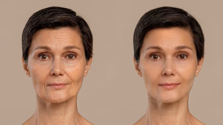 Dermal Fillers vs. Botox: What’s the Difference and Which Is Right for Your Clients?